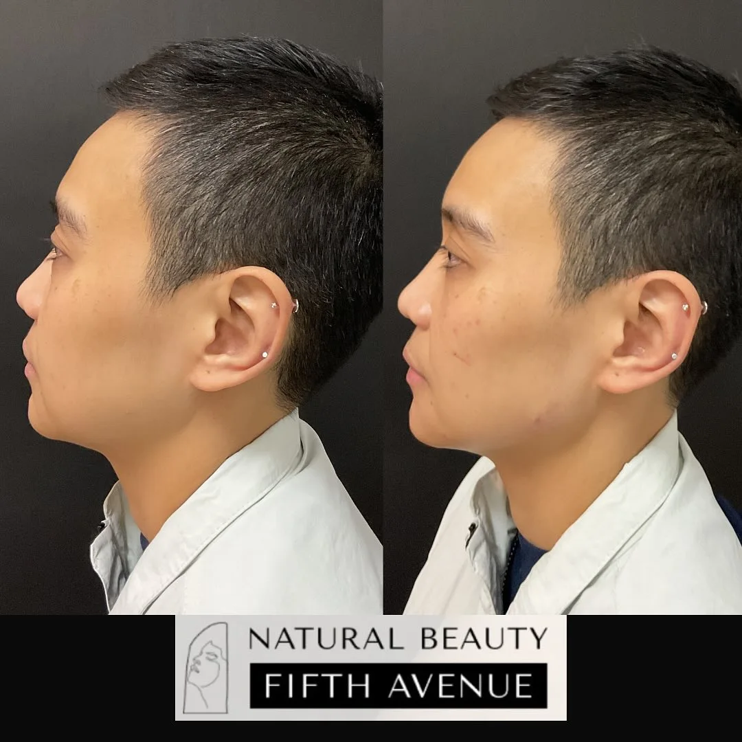 Before and after profile views of dermal filler results at Natural Beauty Fifth Avenue